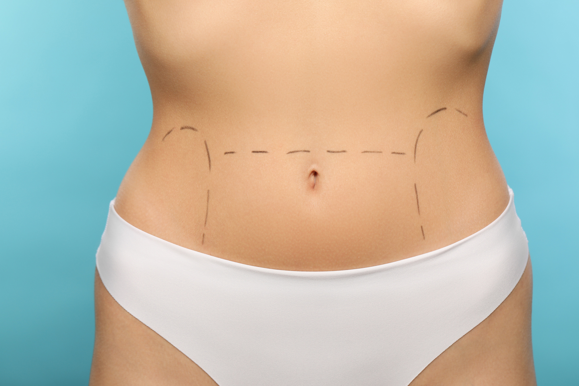 Slim Woman with Markings on Belly before Cosmetic Surgery Operat