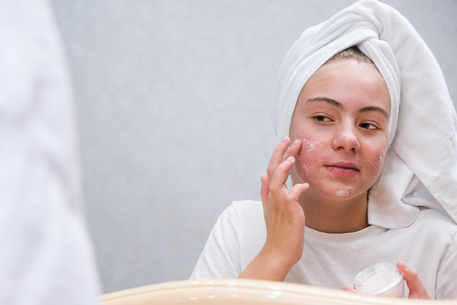 Acne. A teenage girl applying cream to the problematic skin of her face. Acne treatment.